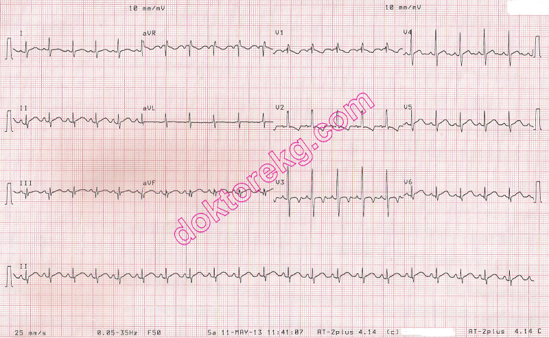 crochetage bulgusu - atriyal septal defekt (asd) - vsd - ekg - ecg ...
