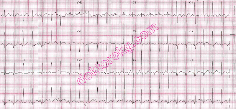 crochetage bulgusu - atriyal septal defekt (asd) - vsd - ekg - ecg ...